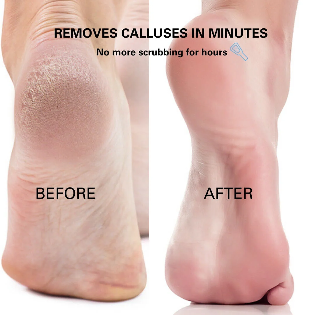 Blissal Rechargeable Foot Callus Remover - Image 5